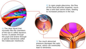 MechanicsOfOpen-AngleGlaucoma